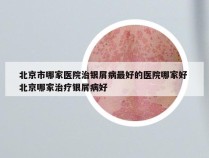 北京市哪家医院治银屑病最好的医院哪家好 北京哪家治疗银屑病好