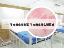 牛皮癣吃哪些菜 牛皮癣吃什么饭菜好