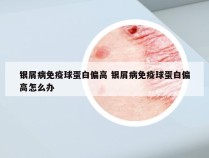 银屑病免疫球蛋白偏高 银屑病免疫球蛋白偏高怎么办