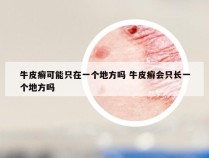 牛皮癣可能只在一个地方吗 牛皮癣会只长一个地方吗