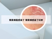 银屑病是感染了 银屑病感染了红肿