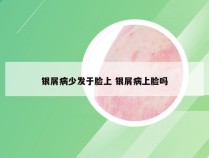 银屑病少发于脸上 银屑病上脸吗