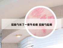 后脑勺长了一些牛皮癣 后脑勺起癣