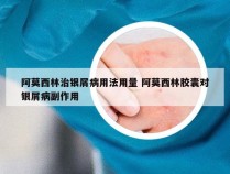 阿莫西林治银屑病用法用量 阿莫西林胶囊对银屑病副作用