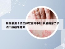 银屑病用卡泊三醇软膏好不好 银屑病涂了卡泊三醇越来越大