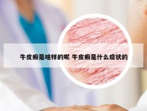 牛皮癣是啥样的呢 牛皮癣是什么症状的