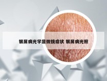 银屑病光学显微镜症状 银屑病光照