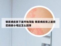 银屑病皮损下面开始发黏 银屑病皮损上面密密麻麻小嘎达怎么回事