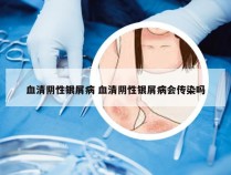 血清阴性银屑病 血清阴性银屑病会传染吗
