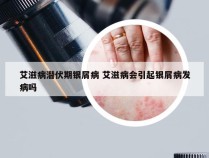 艾滋病潜伏期银屑病 艾滋病会引起银屑病发病吗