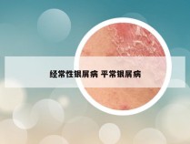 经常性银屑病 平常银屑病