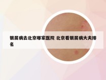 银屑病去北京哪家医院 北京看银屑病大夫排名