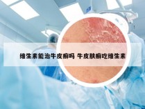 维生素能治牛皮癣吗 牛皮肤癣吃维生素