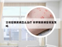 立秋后银屑病怎么治疗 秋季银屑病容易复发吗
