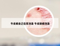 牛皮癣自己在家泡澡 牛皮肤癣泡澡
