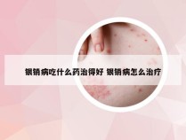 银销病吃什么药治得好 银销病怎么治疗