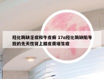 羟化酶缺乏症和牛皮癣 17α羟化酶缺陷导致的先天性肾上腺皮质增生症