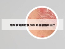 银屑病需要放多少血 银屑病输血治疗