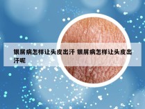 银屑病怎样让头皮出汗 银屑病怎样让头皮出汗呢