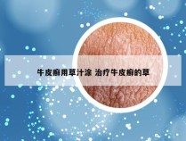 牛皮癣用草汁涂 治疗牛皮癣的草