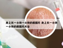 身上长一小块一小块的癣图片 身上长一小块一小块的癣图片大全
