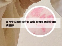 郑州中心医院治疗银屑病 郑州哪里治疗银屑病最好