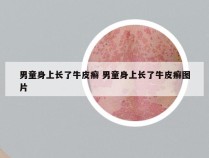 男童身上长了牛皮癣 男童身上长了牛皮癣图片