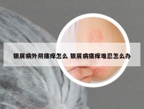 银屑病外阴瘙痒怎么 银屑病瘙痒难忍怎么办