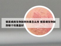 银屑病用生物制剂效果怎么样 银屑病生物制剂哪个效果最好