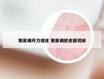 银屑病开刀埋皮 银屑病把皮肤切掉
