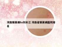 河南银屑病to刘长江 河南省银屑病医院排名