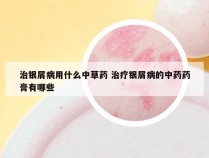 治银屑病用什么中草药 治疗银屑病的中药药膏有哪些