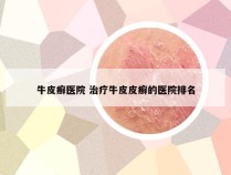 牛皮癣医院 治疗牛皮皮癣的医院排名