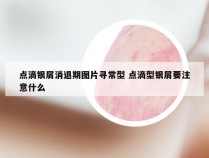 点滴银屑消退期图片寻常型 点滴型银屑要注意什么