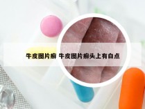 牛皮图片癣 牛皮图片癣头上有白点