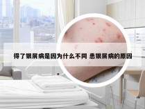 得了银屑病是因为什么不同 患银屑病的原因