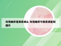 玫瑰糠疹是银屑病么 玫瑰糠疹与银屑病鉴别图片