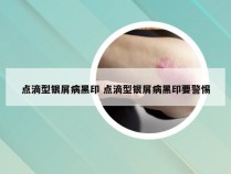 点滴型银屑病黑印 点滴型银屑病黑印要警惕