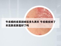 牛皮癣的皮屑刮掉后多久再长 牛皮癣皮掉了长出新皮肤是好了吗