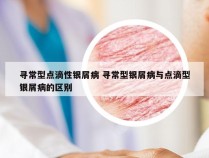 寻常型点滴性银屑病 寻常型银屑病与点滴型银屑病的区别
