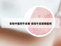 安阳中医院牛皮癣 安阳牛皮肤癣医院