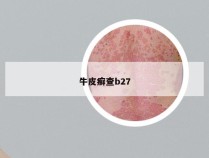 牛皮癣查b27