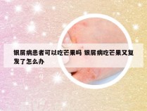 银屑病患者可以吃芒果吗 银屑病吃芒果又复发了怎么办