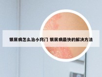 银屑病怎么治小窍门 银屑病最快的解决方法