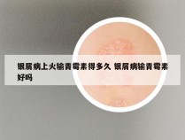 银屑病上火输青霉素得多久 银屑病输青霉素好吗