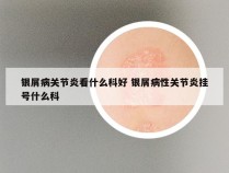 银屑病关节炎看什么科好 银屑病性关节炎挂号什么科