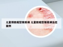 儿童得脓疱型银屑病 儿童脓疱型银屑病治愈案例
