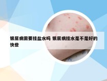 银屑病需要挂盐水吗 银屑病挂水是不是好的快些