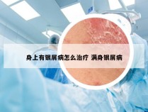 身上有银屑病怎么治疗 满身银屑病