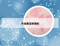 牛皮癣怎样得的
